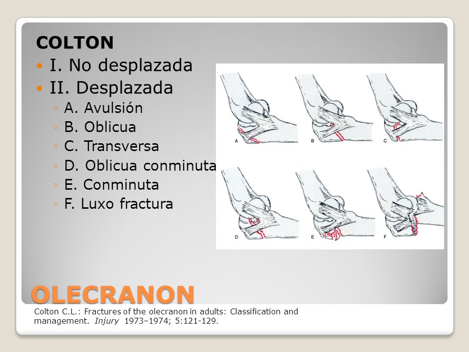 Clasificación de fracturas ppt video online descargar